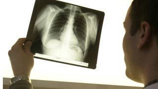 Ein Mediziner betrachtet die Röntgenaufnahme einer Lunge (Quelle: picture-alliance/ BSIP/MENDIL)