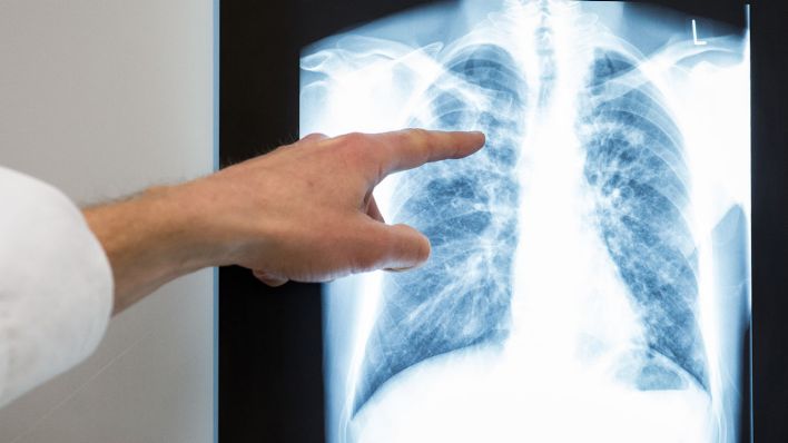 Berlin: Ein Arzt zeigt im Vivantes Klinikum Neukölln auf das Röntgenbild einer Lunge, Archivbild (Quelle: DPA/Silas Stein)