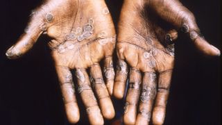 Dieses Bild aus dem Jahr 1997 entstand während einer Untersuchung eines Affenpockenausbruchs in der Demokratischen Republik Kongo (Quelle: CDC/Brian W.J. Mahy)