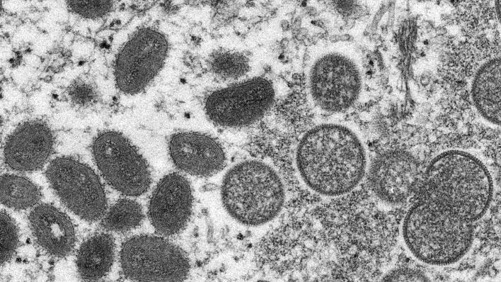 Archivbild: Diese elektronenmikroskopische Aufnahme aus dem Jahr 2003, die von den Centers for Disease Control and Prevention zur Verfügung gestellt wurde, zeigt reife, ovale Affenpockenviren (l) und kugelförmige unreife Virionen (r), die aus einer menschlichen Hautprobe im Zusammenhang mit dem Präriehundeausbruch von 2003 stammt. (Quelle: dpa/C. Goldsmith)