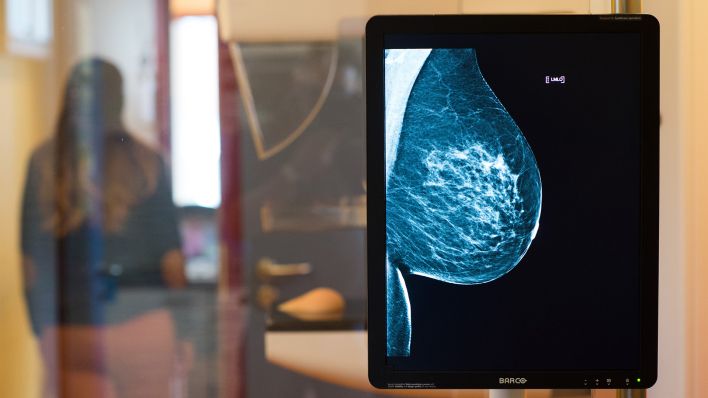 Die Brust einer Frau ist am 25.10.2017 auf einer Röntgenaufnahme zu sehen. (Quelle: dpa/Klaus-Dietmar Gabbert).