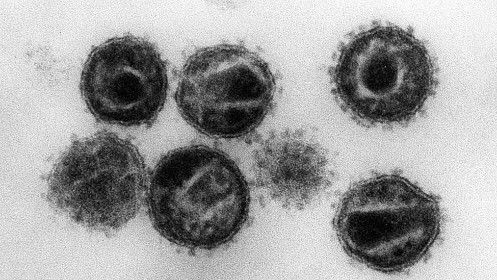Archivbild.Eine undatierte elektronenmikroskopische Aufnahme zeigt mehrere Humane Immunschwäche-Viren (HIV). (Quelle: Robert Koch Institut/Hans Gelderblom)
